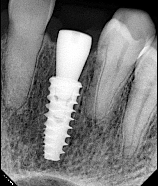 Home Dental Implants