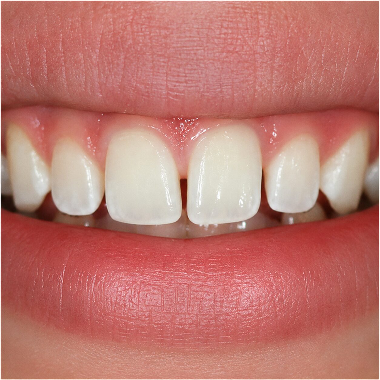 Home After smile